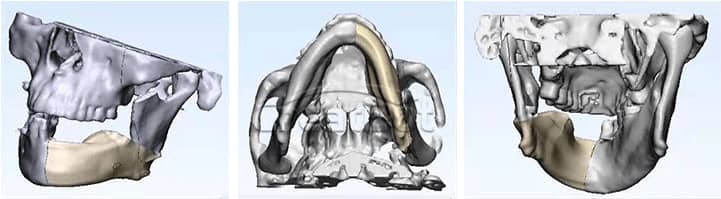 lower jawbone PEEK implant 07