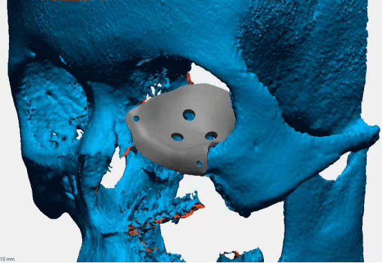 Ngoc Bao Biomedical Vietnam & CreatBot 3D printing