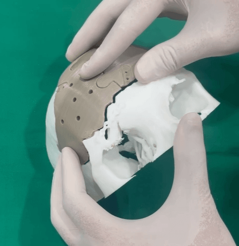 3D printed PEEK cranial implant