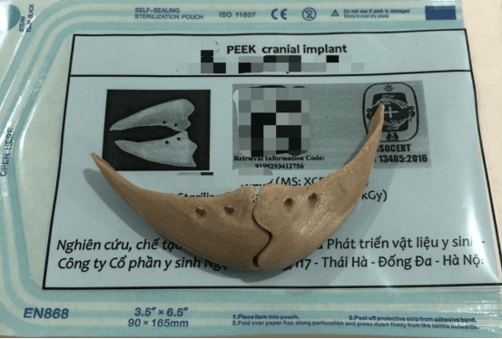 3D printed PEEK maxillofacial implant