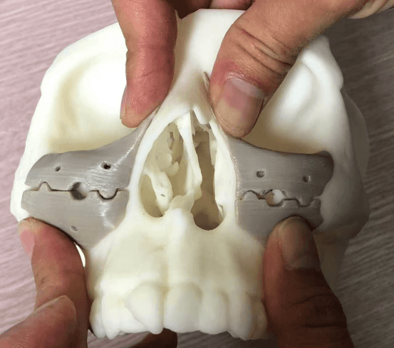 3D printed PEEK nasal and orbital model