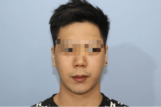 Ngoc Bao Biomedical Vietnam PEEK implant application case